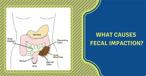 Fecal impaction: Symptoms, causes, an